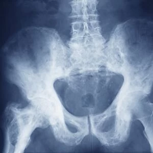 Pelvis in Pagets disease, X-ray