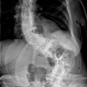 Scoliosis of the spine, X-ray C017 / 7167