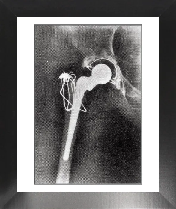 Framed Print : X-ray Hip Joint Replacement Print Framed Print : X-ray Hip Joint Replacement Print