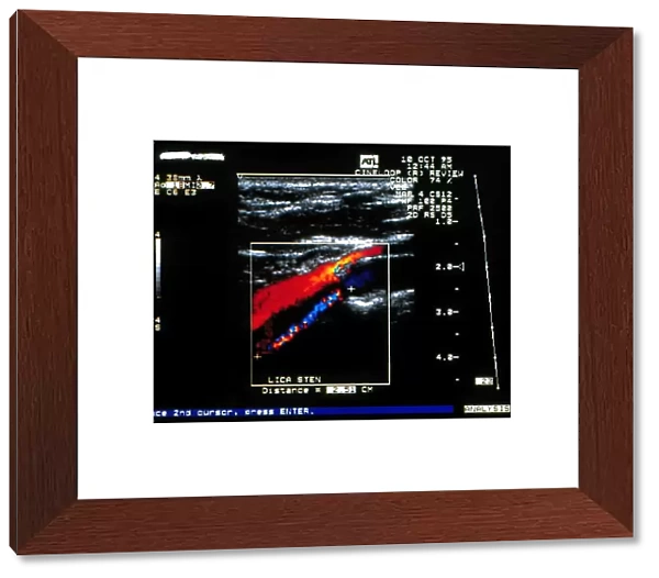 Doppler ultrasound scan of carotid artery stenosis
