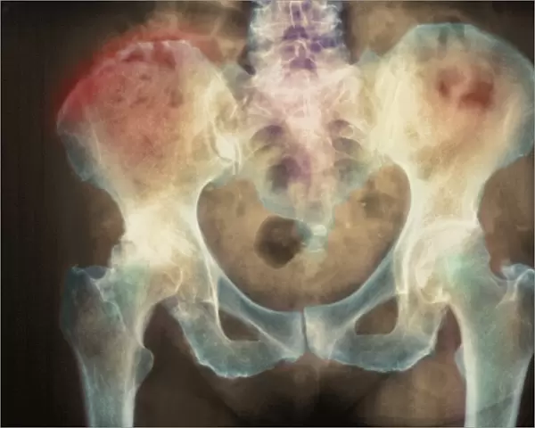 Bone death, X-ray