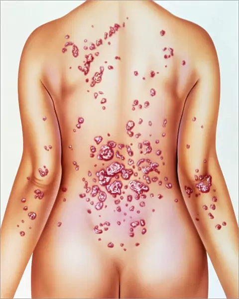 Artwork of psoriasis on womans back