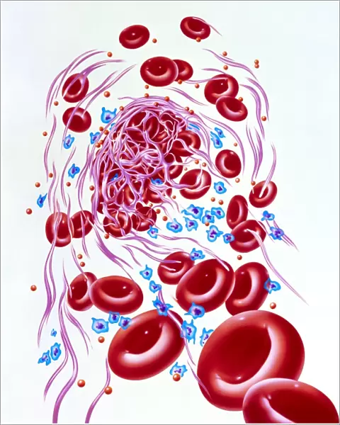 Illustration of a dissolving blood clot (thrombus)