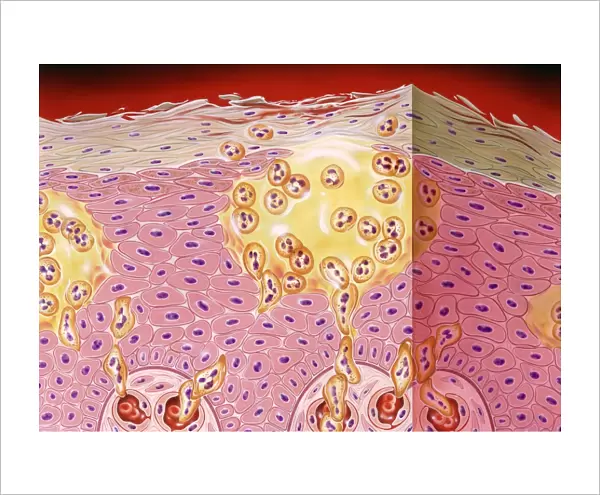 Psoriasis. Artwork of a section through the skin in a case of pustular psoriasis