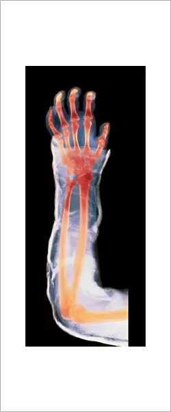 Broken arm in plaster cast, X-ray