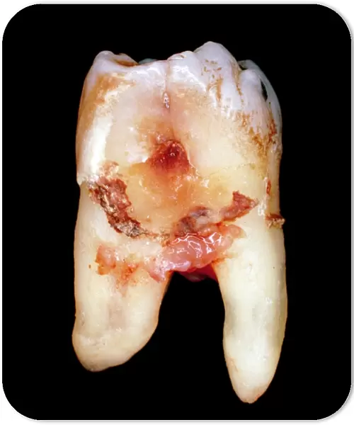 Extracted molar