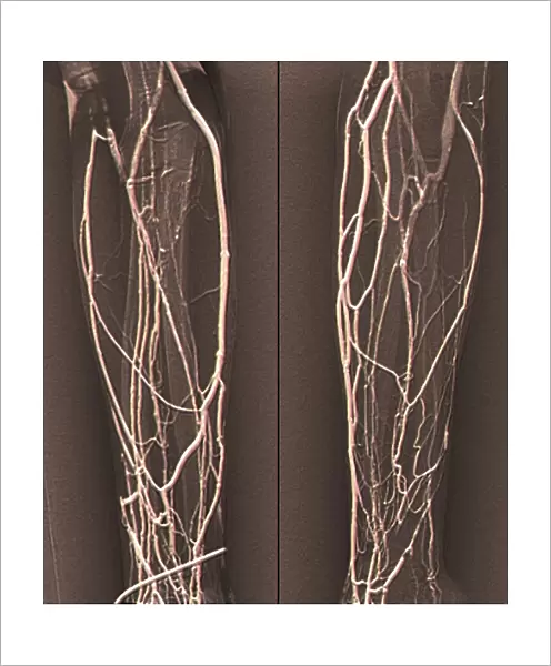 Forearm veins, X-ray C018  /  0474
