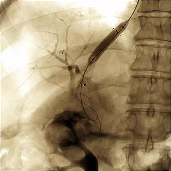 Portal vein surgery, X-ray C016  /  6545