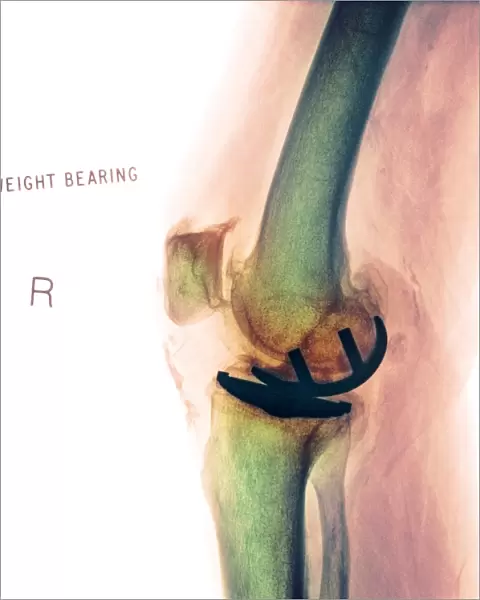 Osteoarthritis of the knee, X-ray F008  /  3461