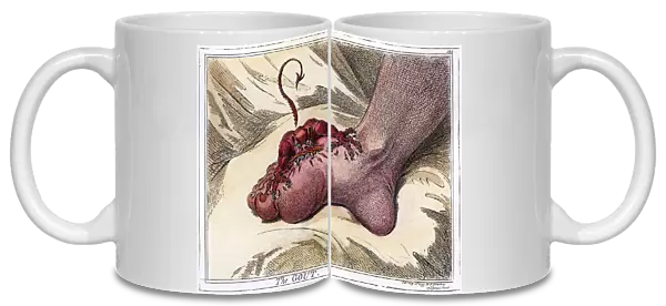 The Gout. Etching, 1799, by James Gillray