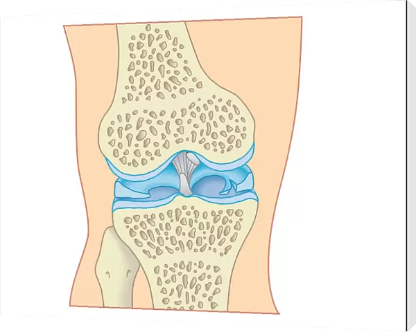 Digital cross section illustration of torn cartilage in knee