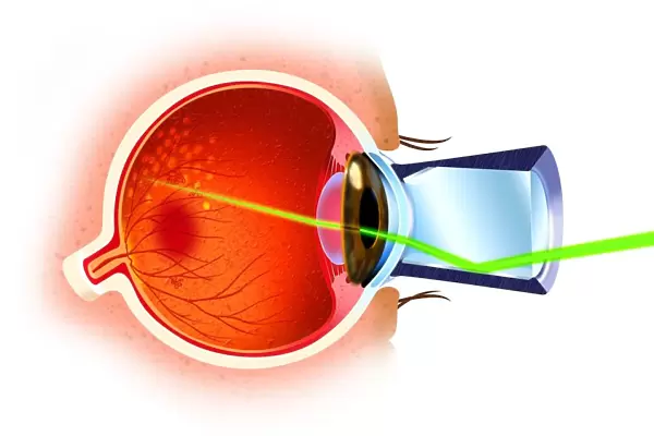 Cross section of eye ball, laser ray entering through pupil, directed at eye nerves