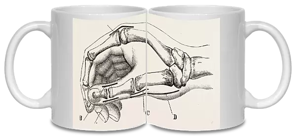 excision of metacarpo-phalangeal joint, medical equipment, surgical instrument, history