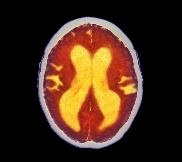 Alzheimers disease brain, coloured CT scan