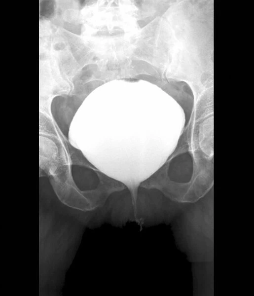Full bladder, X-ray cystography