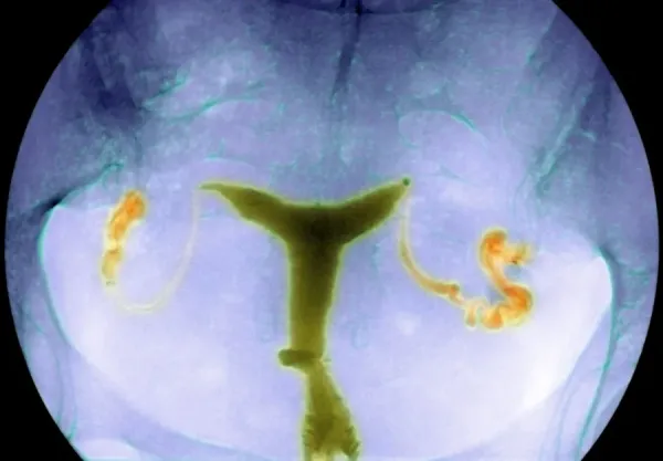 Blocked Fallopian Tubes, Coloured X-ray Art Prints, Posters