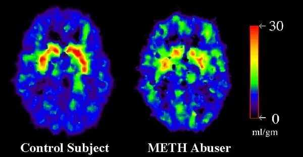 Brain damage due to drugs, PET scans C014  /  1177
