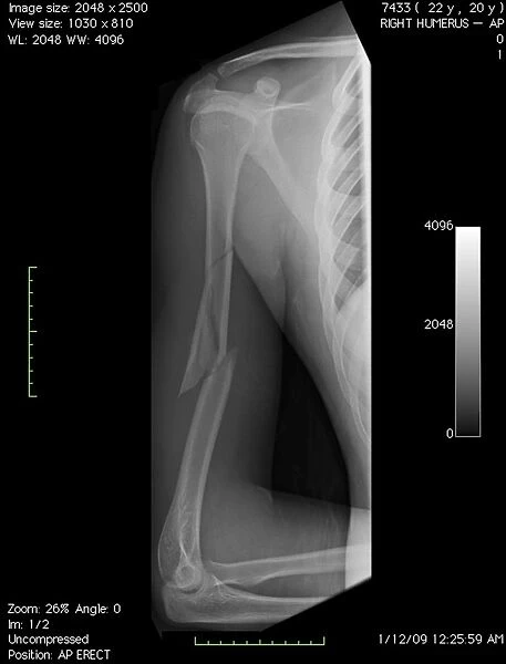 Broken arm bone, digital X-ray