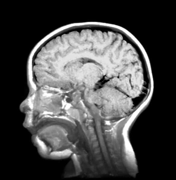 Childs brain, MRI scan