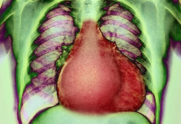 Enlarged heart, X-ray