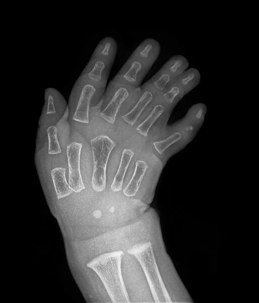 Extra fingers, X-ray C017  /  8007