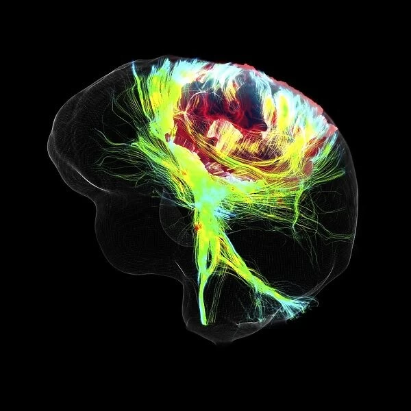 Glioblastoma brain tumour, DTI MRI scan C017  /  7052