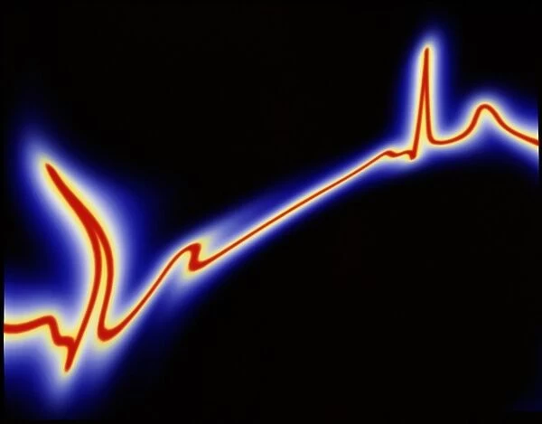 Heart disease: artwork of an irregular ECG trace