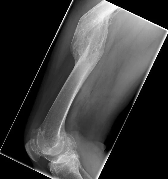 Malunited fracture, X-ray C017  /  7641