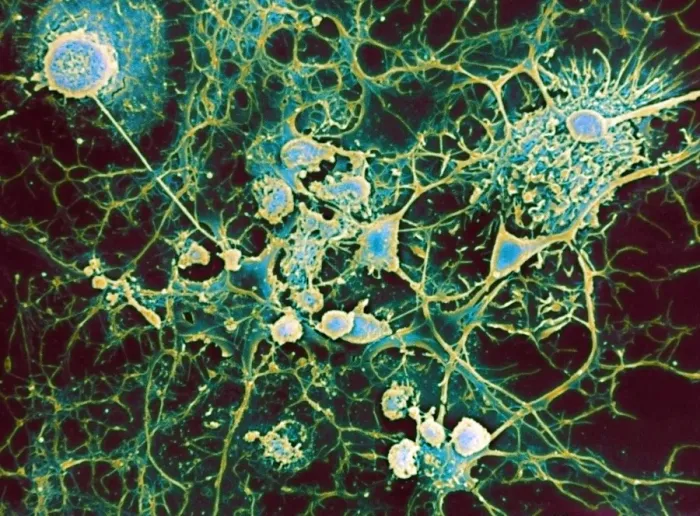 Framed Print : Multiple sclerosis Print, SEM image Framed Print : Multiple sclerosis Print, SEM image