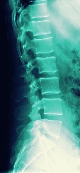 Normal spine, X-ray. Normal spine. Coloured profile X-ray showing bones of the spine 