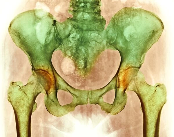Osteoarthritis of hip joints, X-ray
