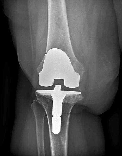 Prosthetic knee and obesity, X-ray C016  /  6593