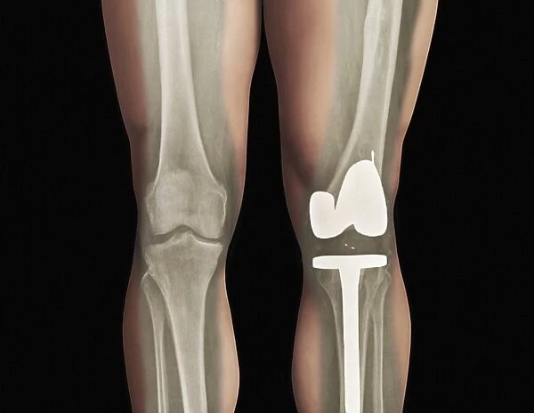 Total knee replacement, X-ray
