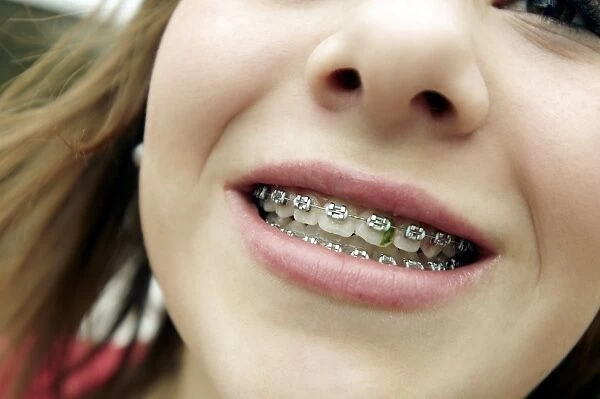 Trapped food in dental braces