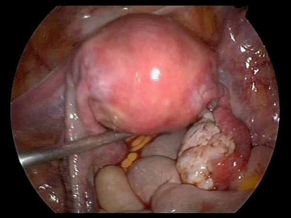 Uterus, endoscope view C017 / 6805
