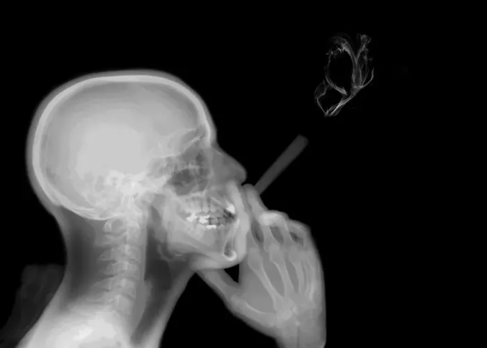 chest x-ray cigarette smoking Cigarettes as radioactive as x-rays  ABC Science Archive 95 X Ray Of Smokers