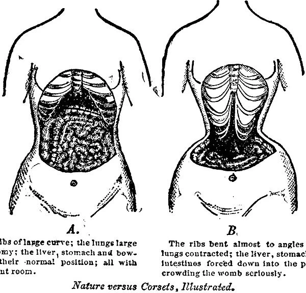 Two pictures of a womans torso, one showing a woman without
