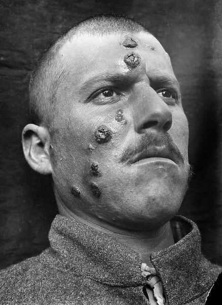 SKIN INFECTION, 1917. A Middle Eastern man affected with the parasitic disease