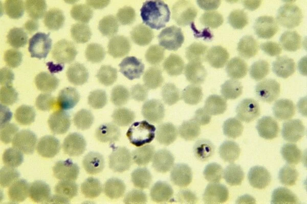 Malaria, Plasmodium vivax in blood under microscope