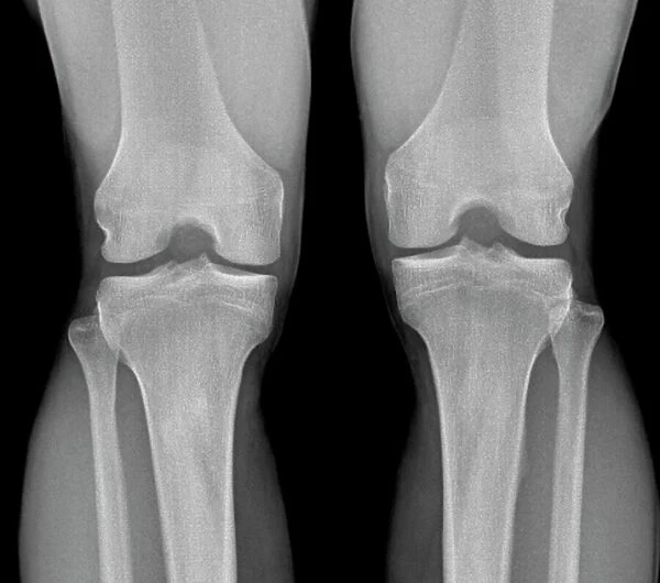 Normal knees, X-ray. Normal knees. Frontal X-ray of the flexed knees of