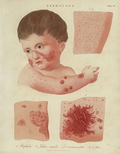 Skin diseases of infants