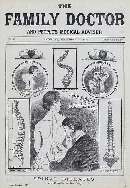 Spinal diseases (engraving)