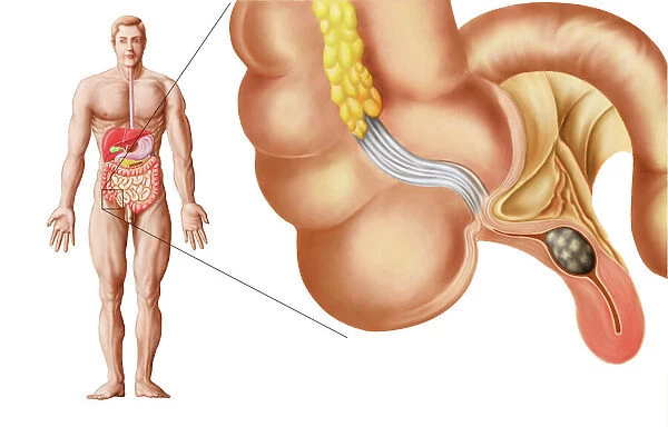 Medical ilustration of an appendix with appendicitis