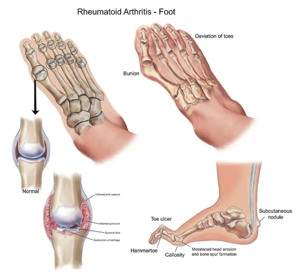 Rheumatoid Arthritis In Bunion And Heel Pain Rheumatoid Arthritis