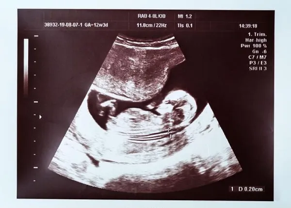 Ultrasound scan of a 20 Art Prints, Posters