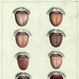 The tongue of a yellow fever sufferer
