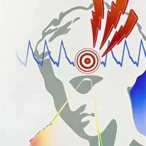Artwork of scotoma visual disturbance in migraine