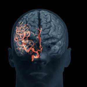 Brain aneurysm, 3D scan