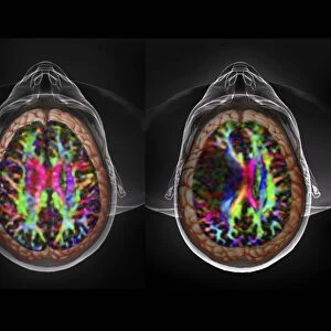 Brain cancer, DTI and 3D CT scans C016 / 6414