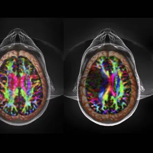 Brain cancer, DTI and 3D CT scans C016 / 6414